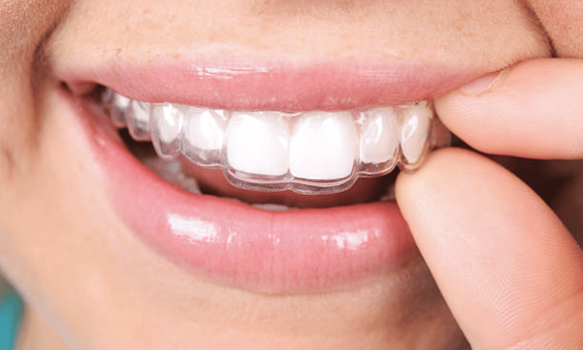 Invisalign