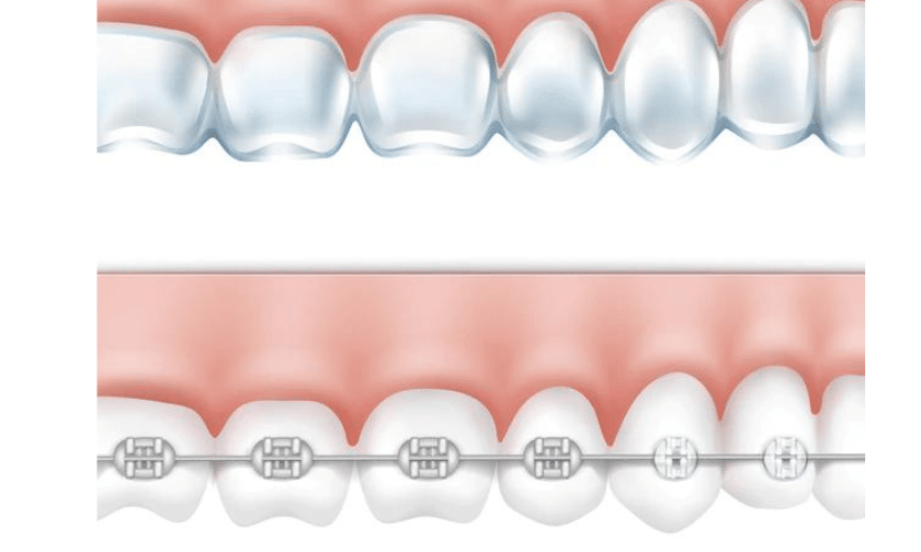 Braces Issues You Can Prevent With Invisalign