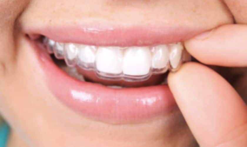 Invisalign Aligner in Delray