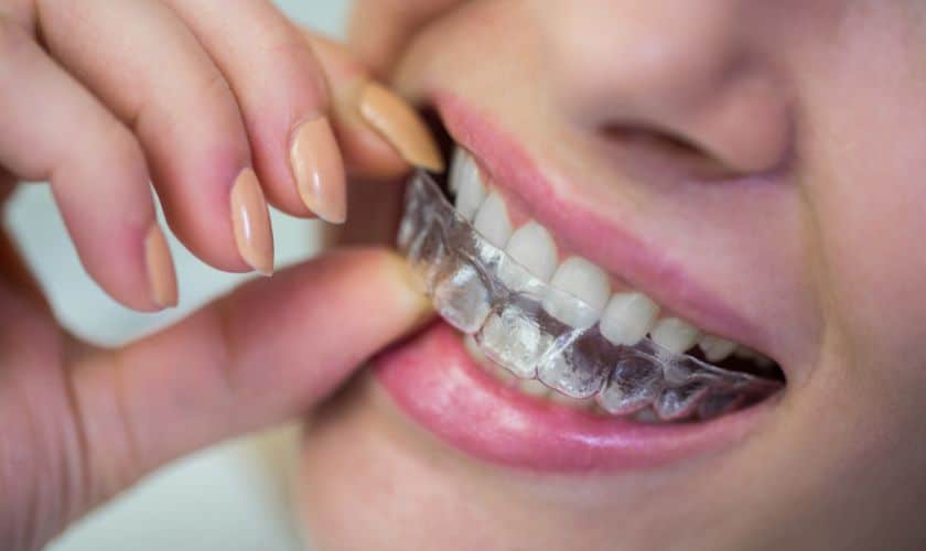 Invisalign Braces