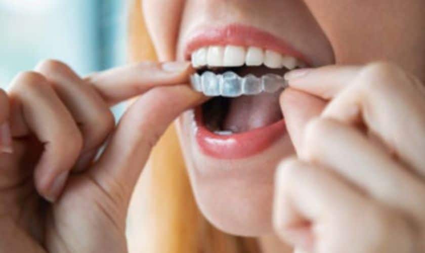 Invisalign Aligner Delray