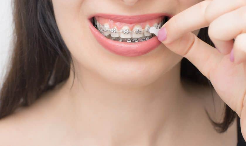 Braces in Delray