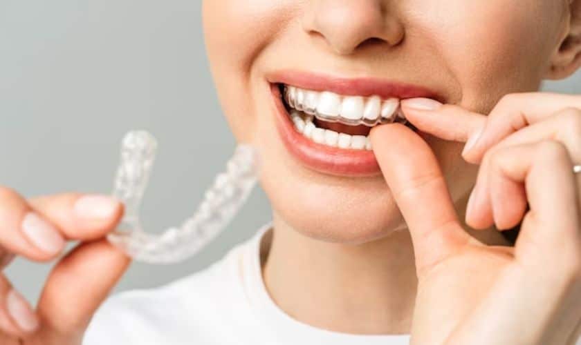 Invisalign Aligner Delray Beach