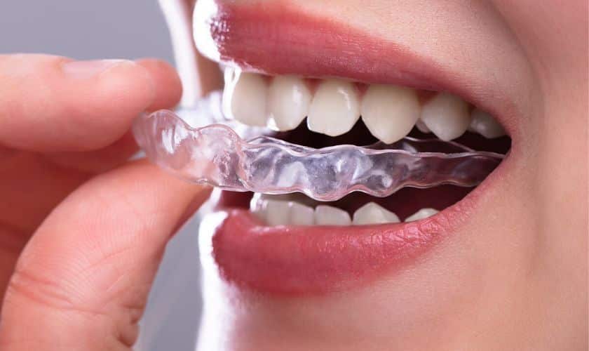 Invisalign Aligner in Delray