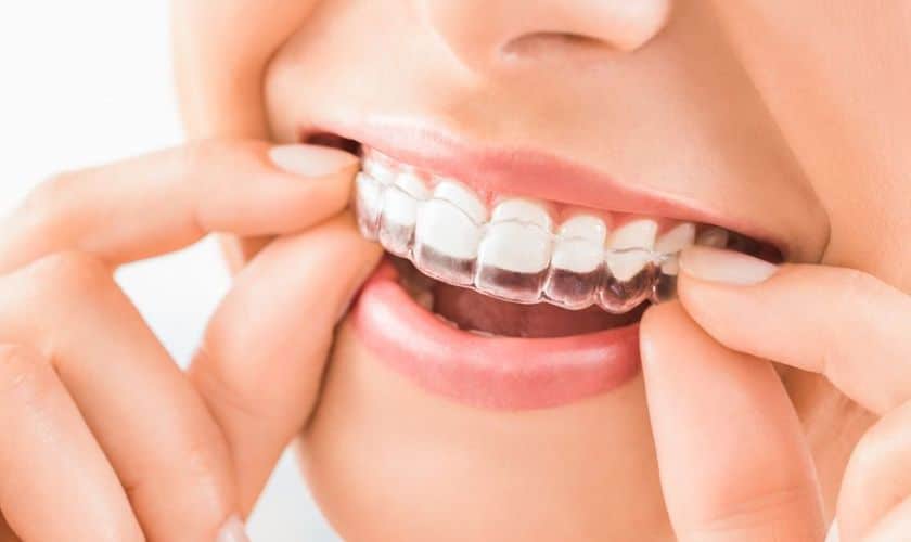 Delray Beach Invisalign