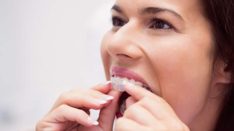 Invisalign Aligner in Delray Beach