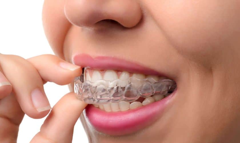 Invisalign Aligner in Delray Beach