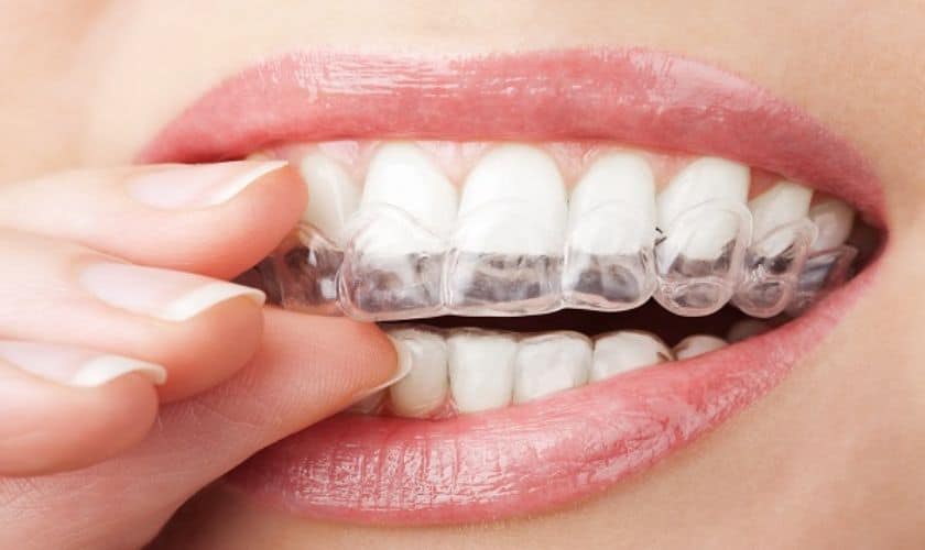 Invisalign in Delray Beach