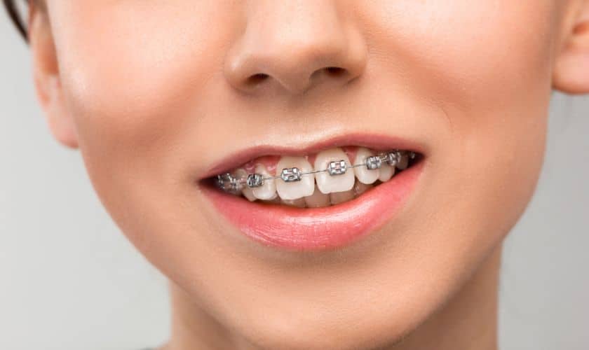 Orthodontic Treatment in Delray Beach