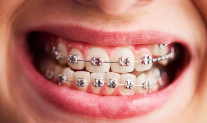 Orthodontist in Delray Beach