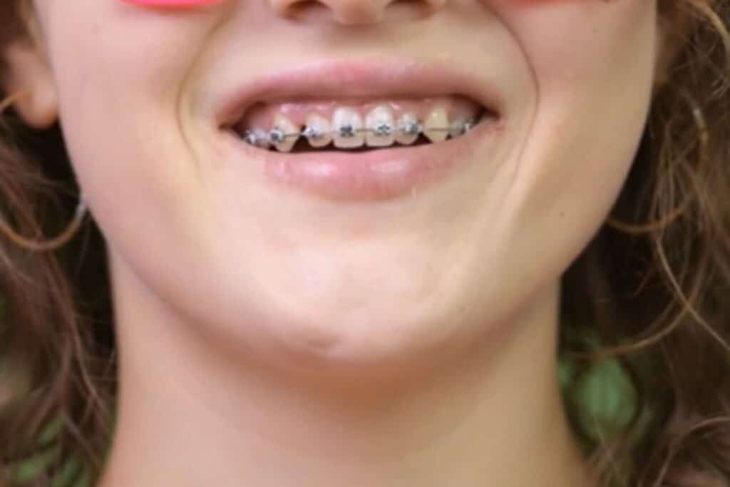 Orthodontist in Delray Beach