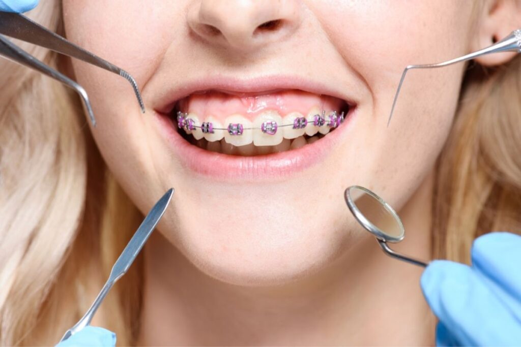 Orthodontic Treatment Delray Beach