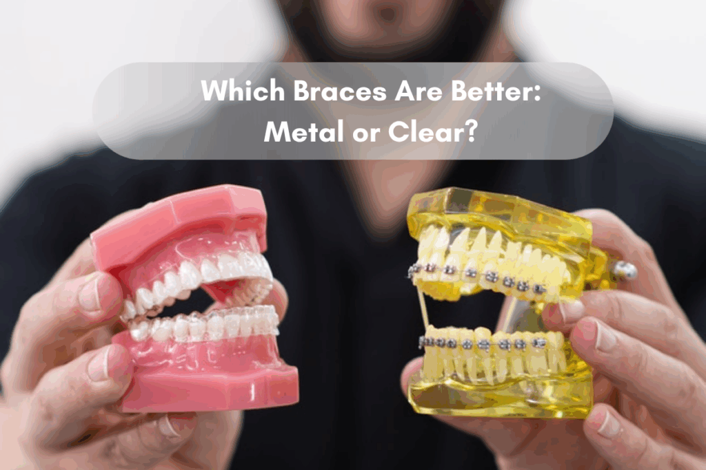 Which Braces Are Better Metal or Clear