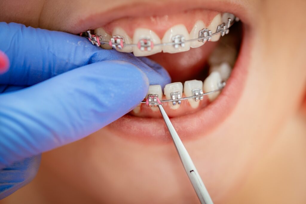 How to Keep Clear Braces from Turning Yellow