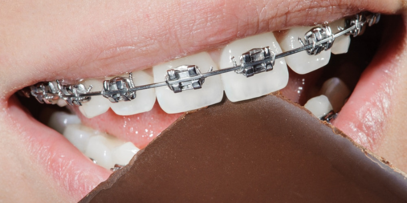 Chocolate with Dental Braces
