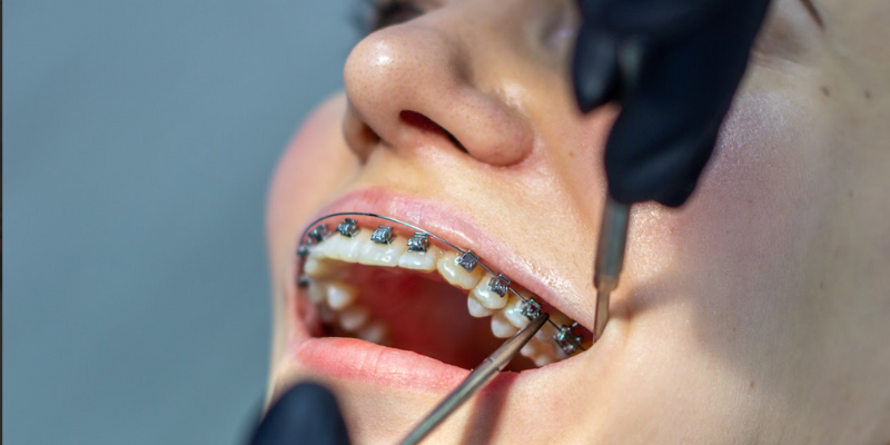 Delray Beach Residents Braces