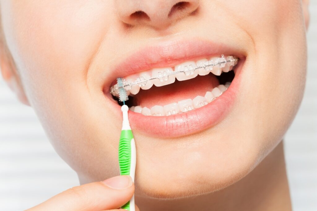 How to Maintain Oral Hygiene with Clear Braces