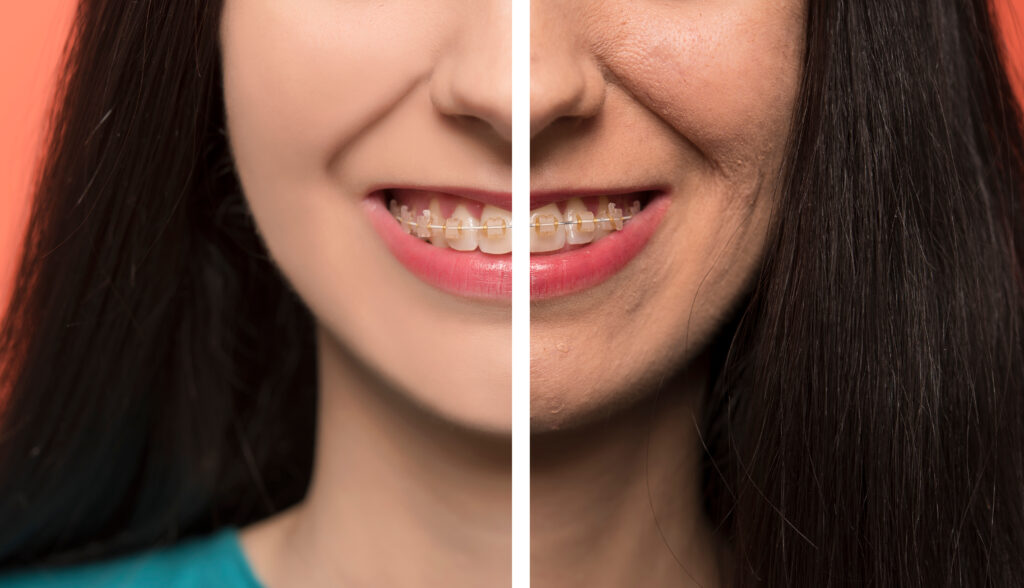 Role of Orthodontists in Cosmetic Smile Transformations