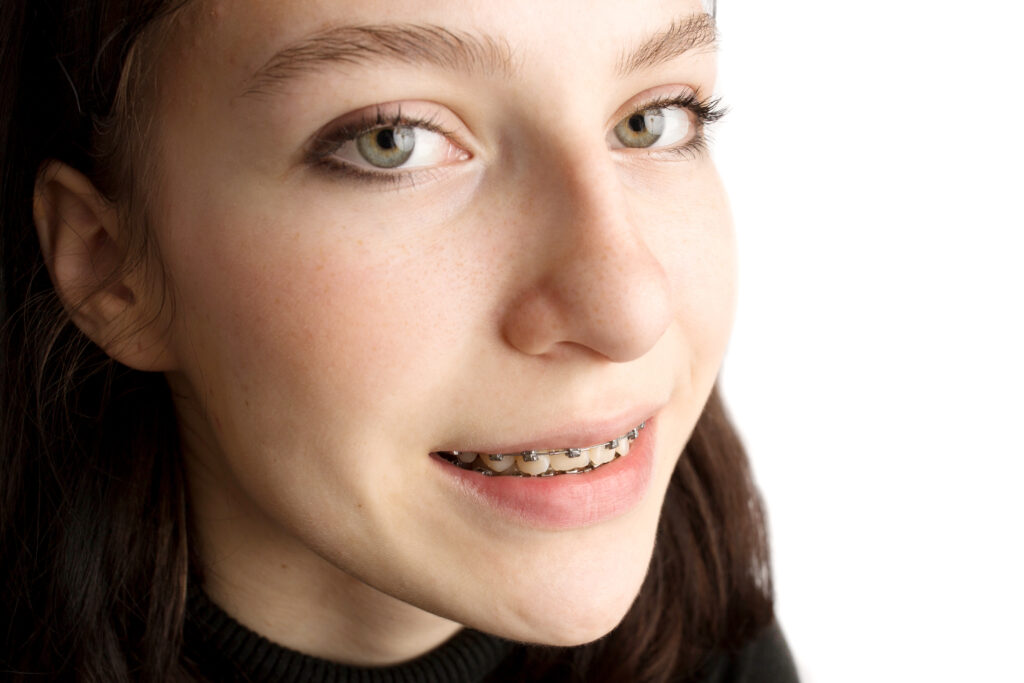 Braces Remain a Trusted Orthodontic Solution