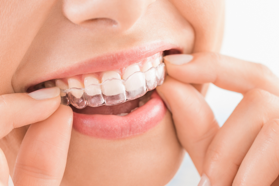 Invisalign Aligners Create Straighter Teeth Discreetly