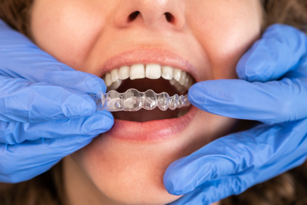 Invisalign Attachments: What They Are and Why They’re Needed