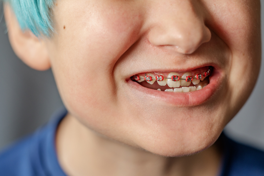 Types of Braces You May Not Have Thought to Ask About