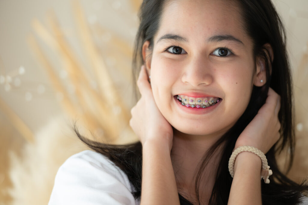 LightForce Clear Braces