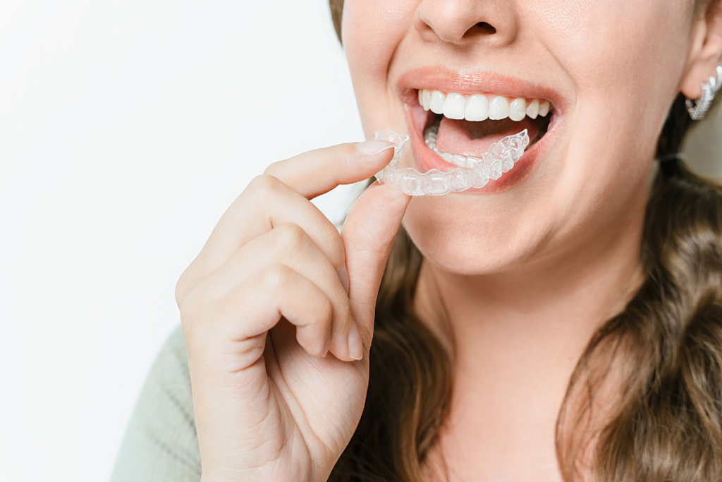 10 Lifestyle Benefits of Invisalign for Adults