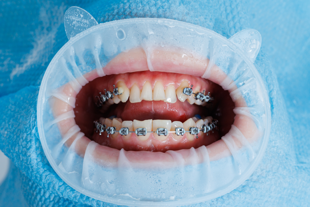 LightForce Braces