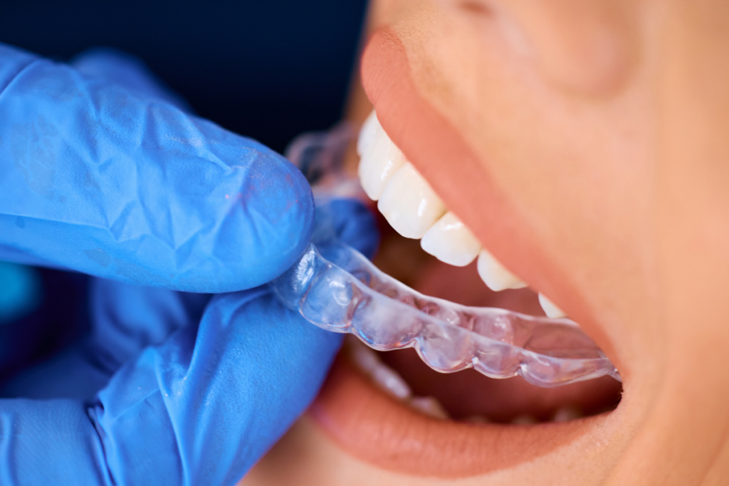 Step-by-Step Invisalign Process