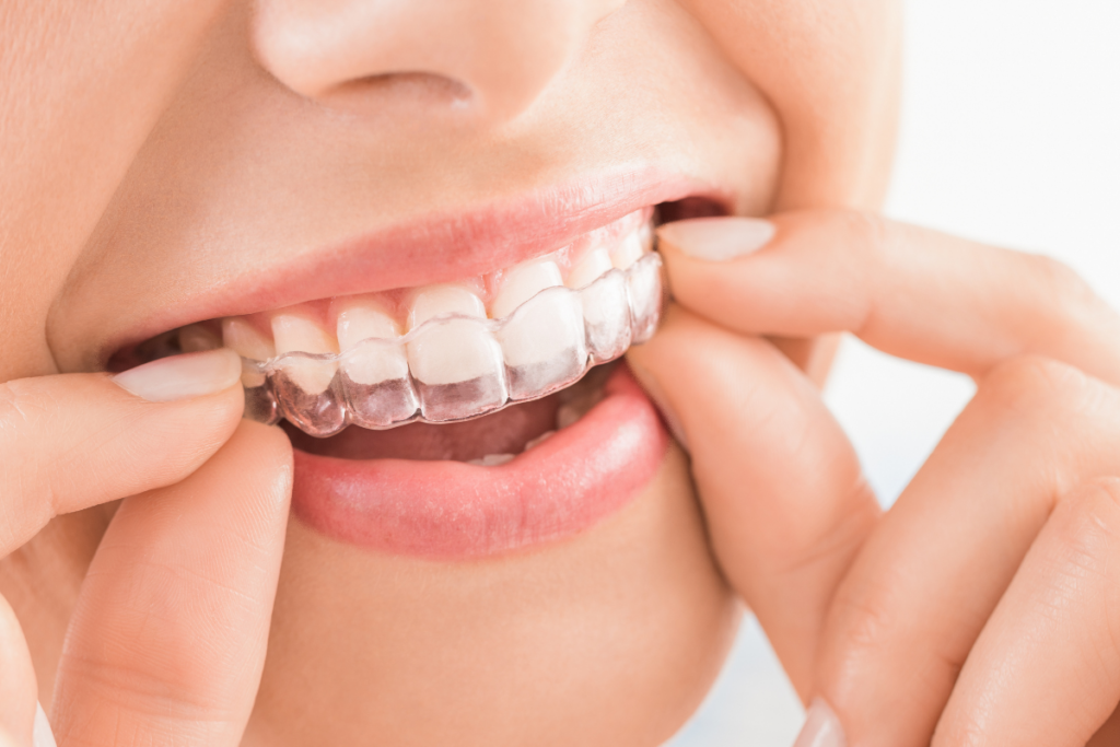 Invisalign for Teeth Straightening