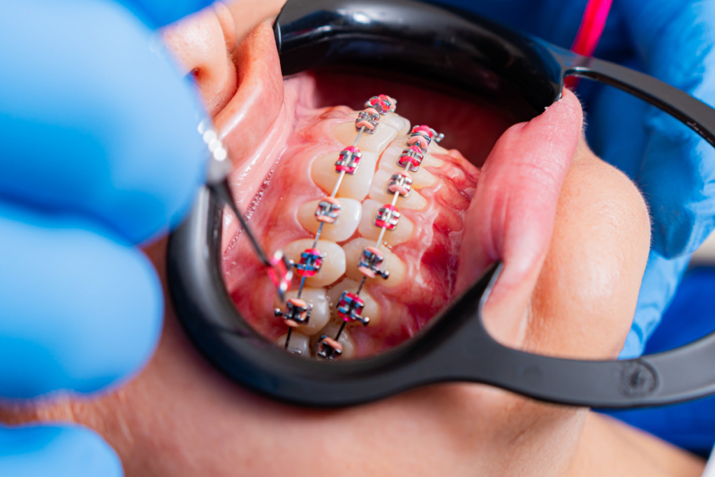 7 Hidden Signs You May Need Braces Even If Your Teeth Look Straight