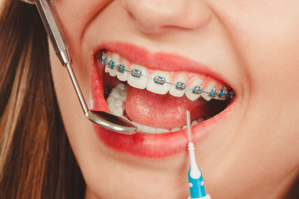 Patient with braces receiving interdental cleaning during dental examination.