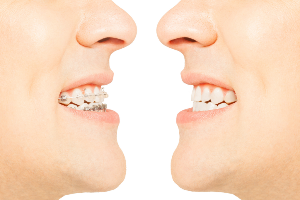 Can OrthoDentistrydontics Improve a Smile Before Cosmetic?